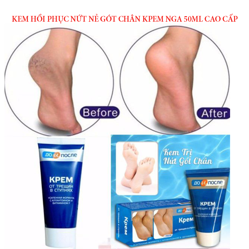 Kem Ngừa Nứt Nẻ Gót Chân Kpem - Ngừa nứt nẻ gót chân, giữ ẩm cho da, làm mềm da chân, mau kéo da non, giúp tái tạo da gót chân, tái tạo da khô