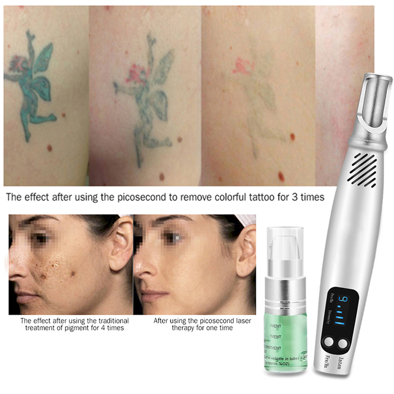 Tattoo Removal Beauty Equipment (RY 580) - China Laser Tattoo Removal, Tattoo  Removal | Made-in-China.com