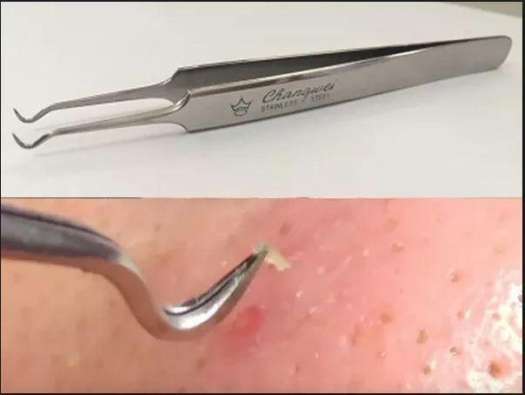 Nhíp gắp mụn cám Hàn Quốc