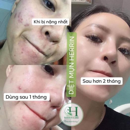 Trị Mụn Herrin Care 24h Không Sưng - Không Bong - Không Đỏ - Không Rát