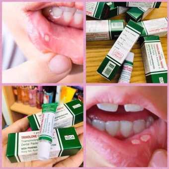01 Tuýp Kem Bôi Nhiệt Miệng Trinolone Oral Paste Thái Lan
