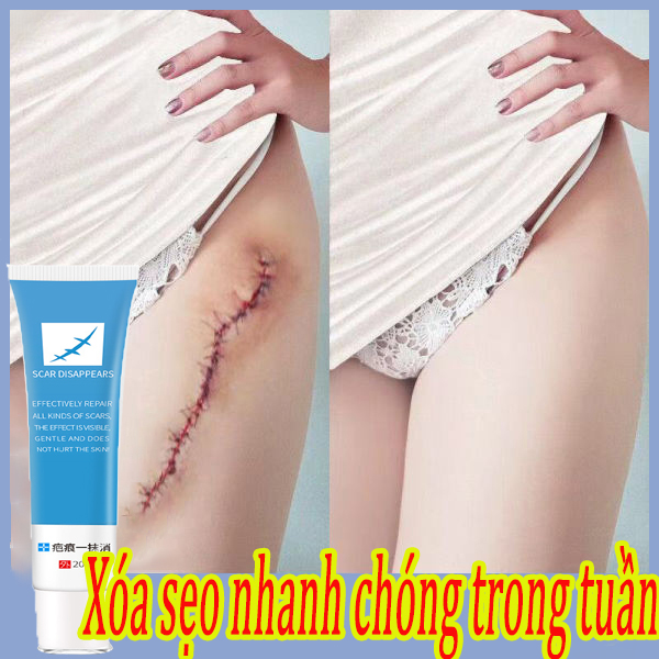 Kem loại bỏ sẹo trắng da, xóa sẹo chuyên nghiệp do ngã, bỏng, sẹo mụn, phục hồi da trầy xước, xóa sẹo mụn, giảm thâm, phục hồi da. Kem xoá sẹo 20g