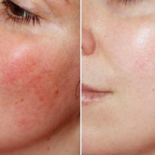 Tinh Chất Serum Phục Hồi Hydra 5 Comllex Cellex-C