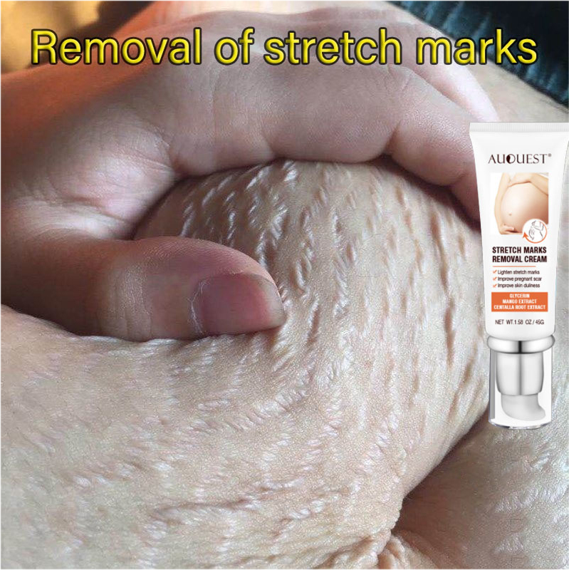Gambar Stretch marks remover Body Repair cream[45g]  Pregnant Women Healthy, Firming Belly, Preventing and Eliminating Growth Strokes, Abdomen, Thighs, Arms