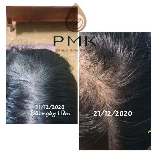 Tinh Chất Tóc Cao cấp Minh Khang - Kích Thích Mọc Tóc & Ngăn Ngừa Rụng Tóc Cực Kì Hiệu Quả [DTM]