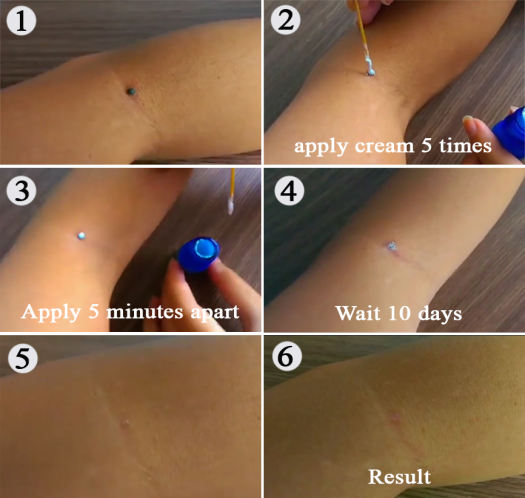 Kem Tẩy Nốt Ruồi POOLA Chính Hãng