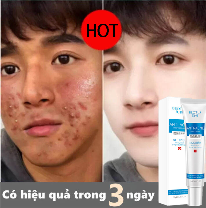 [100% nguyên bản]Kem mụn,Kem chấm mụn thâm cấp tốc cho nam giới nữ giới,gel mụn,Kem Hết Mụn, Xóa thâm ,skinacne,giúp dưỡng trắng da xóa thâm liền sẹo,Kiểm Soát Dầu,Dưỡng ẩm và Nuôi giảm vết thâm mụn