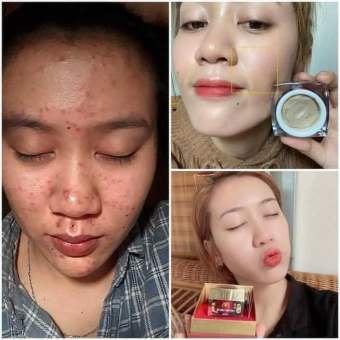 CAO MỤN SÂM ĐỎ - Đánh bay Mụn tận Gốc