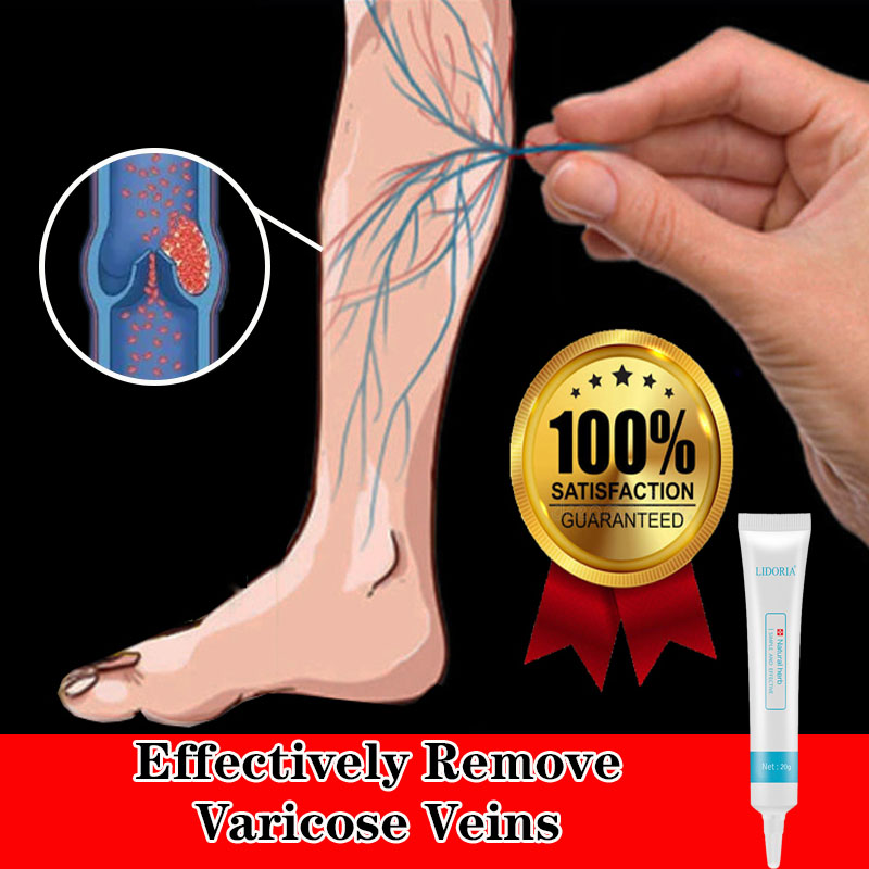 Gambar Varicose vein Cream Effective Anti Varicose Veins Ointment 20G