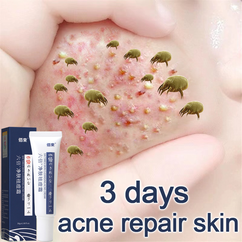 Gambar Remove Acne Cream anti pimples Acne Treatment ointment acne remover eliminates redness and swelling acne cream acne cream Krim Jerawat muka jerawat muka jerawat badan anti jerawat