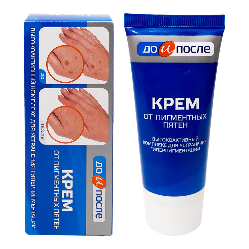 Kem chống đồi mồi da tay kpem, kem ngăn đồi mồi đốm nâu hàng nga