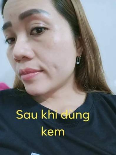 Kem nám tàn nhang đồi mồi EVER TODAY (6g)