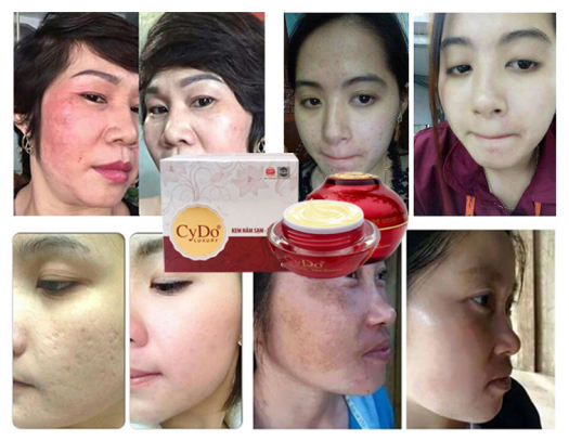 KEM TRỊ NÁM SẠM TÀN NHANG LUXURY CYDO