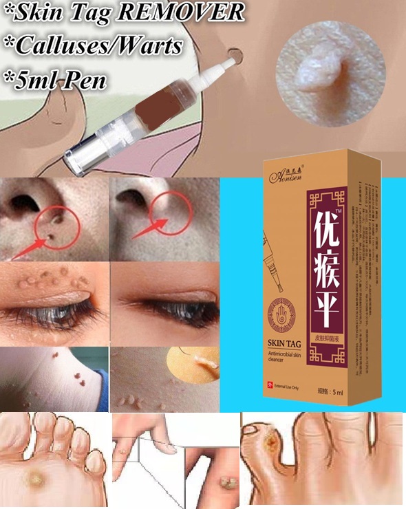 Kem bôi mụn thịt, MỤN nốt duồi, mụn cóc, , mụn cơm, nám tàn nhang hết bay nhanh trong nốt nhạc