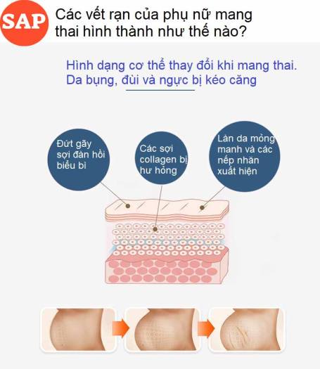 Kem Hết Rạn Da, Hết Sẹo Hiệu Quả Treatment Body Cream Thương Hiệu VIBRANT GLAMOUR Làm Trắng Và Săn Chắc Mịn Mượt Chống Lão Hóa