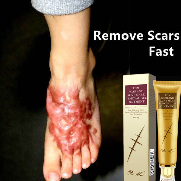 【Hot Sale】Face and Body Scar Removal Cream Nourishing Deeply Repairing Scarred Skin Repairing Acne Scars Improving Skin Elasticity Hydrating Whitening Scar Repair CreamAcne Scar Removal Cream Skin Care Product Pigmentation Corrector Whitening Cream