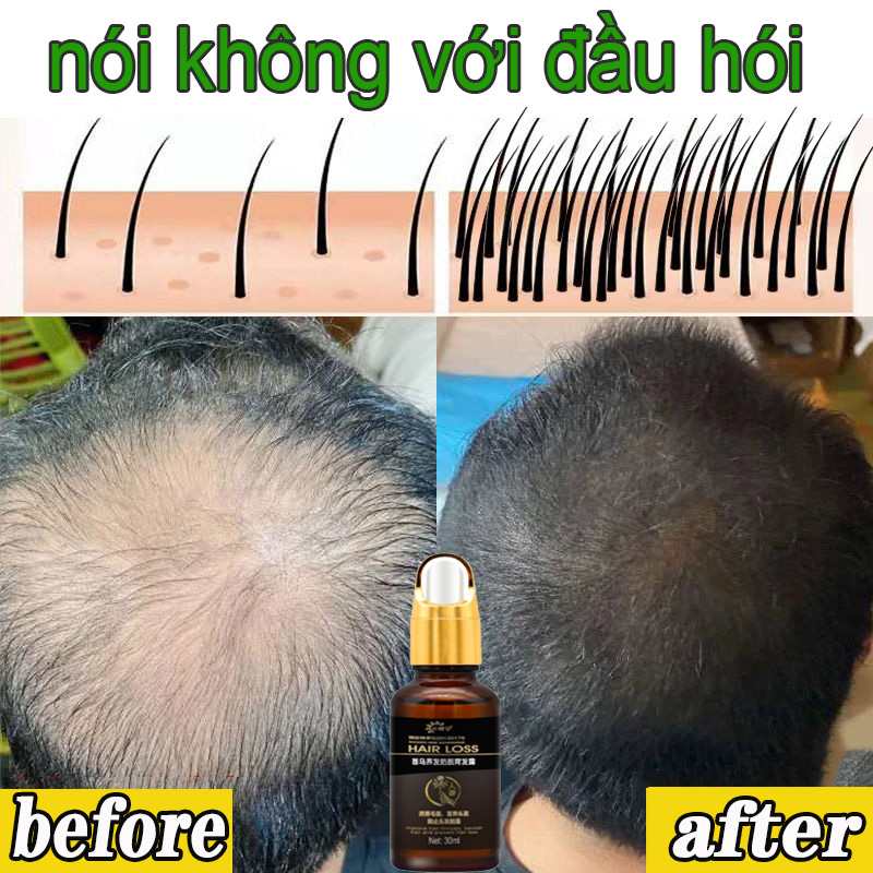 TInh chất mọc tóc Kích Thích Mọc Tóc, Ngăn Rụng Tóc Tinh dầu kích mọc tóc 30ml tinh chất giúp tóc mọc nhanh giúp giảm rụng tóc, kích mọc tóc nhanh cho mái tóc dày và dài hơn gấp 2 lần đến 3 lần