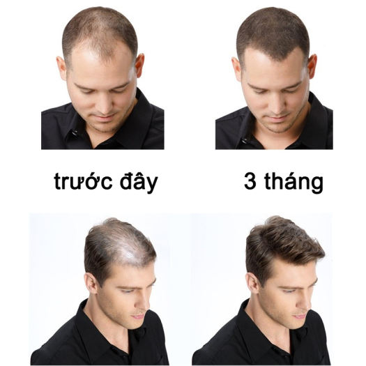 TOP 7+ Thuốc kích thích mọc tóc cho nam giới hiệu quả tốt nhất