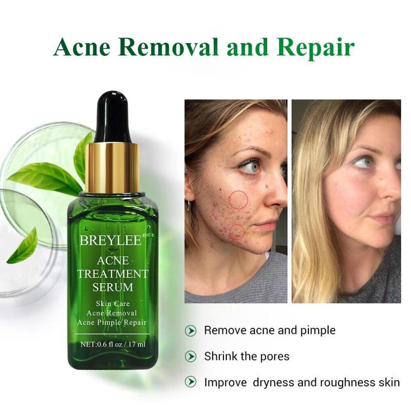 Serum BREYLEE Acne Treatment Kit Mụn Chăm Sóc Da Mặt Kem Dưỡng Da Mặt Skincare Mụn ẩn Chấm Mụn Serum Dưỡng Da Dàm Trắng 17ml