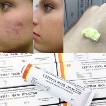 Kem lưu huỳnh Nga, Kem xóa sạch mụn bọc, mủ, trứng cá Cephar