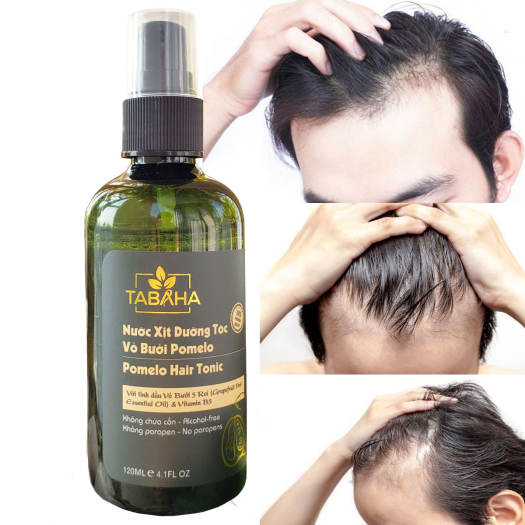 Rụng tóc ở nam giới tuổi 30: Nguyên nhân và cách khắc phục | Phòng khám Da  liễu thẩm mỹ Bác sỹ Thái Hà