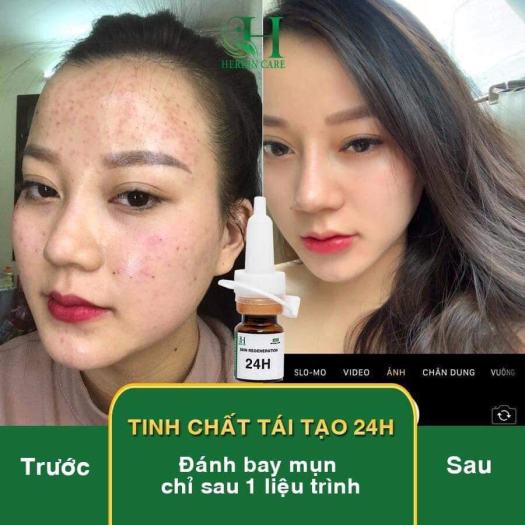 Trị Mụn Herrin Care 24h Không Sưng - Không Bong - Không Đỏ - Không Rát