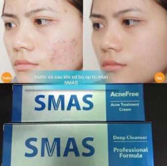 KEM TRỊ MỤN SMAS ACNESFREE