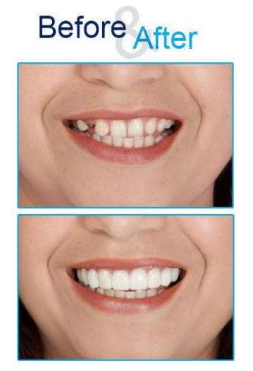 Răng giả Snap on smile