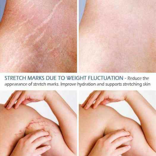 VIBRANT GLAMOUR Kem Trị Rạn Da Xóa Sẹo Cho Da Mịn Màng Phục Hồi Da Sau Sinh Loại Bỏ Vết Nứt Do Tăng Cân