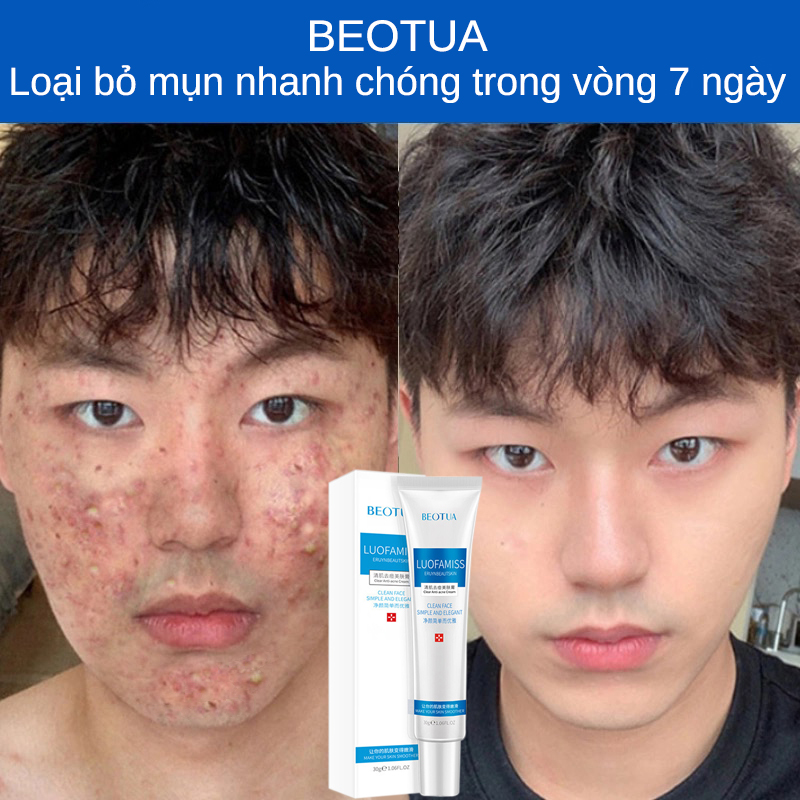 Kem mụn,Kem chấm mụn thâm cấp tốc cho nam giới nữ giới ,Làm sạch mụn Kem làm sạch mụn, Xóa vết thâm mụn ,Cải thiện tình trạng xỉn màu ,giảm kích ứng da dưỡng ẩm cấp nước, kháng khuẩn chống viêm Giúp dưỡng trắng da xóa thâm liền sẹo