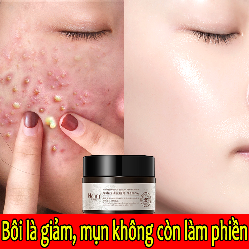 [HCM]kem xóa mụn gel xóa mụn kem xóa mụn thảo mộc 30g xóa mụn nhanh chóng làm mờ thâm mụn thu nhỏ lỗ chân lông giảm mụn phục hồi làn da mịn màng làm trắng da