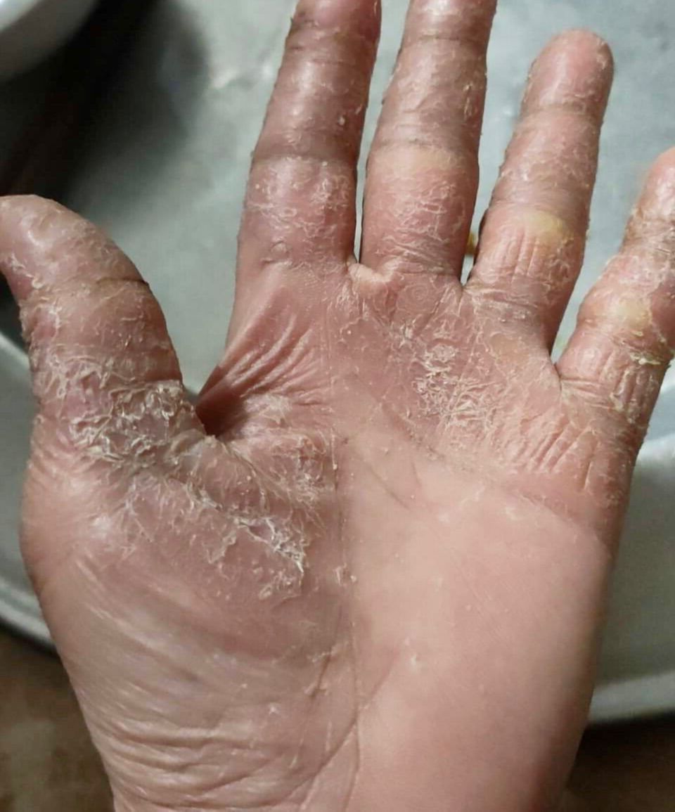 Thảo dược quý Khỏi bong da đầu ngón tay ngón chân, lòng bàn tay, bàn chân (Đông Y Cổ Truyền)