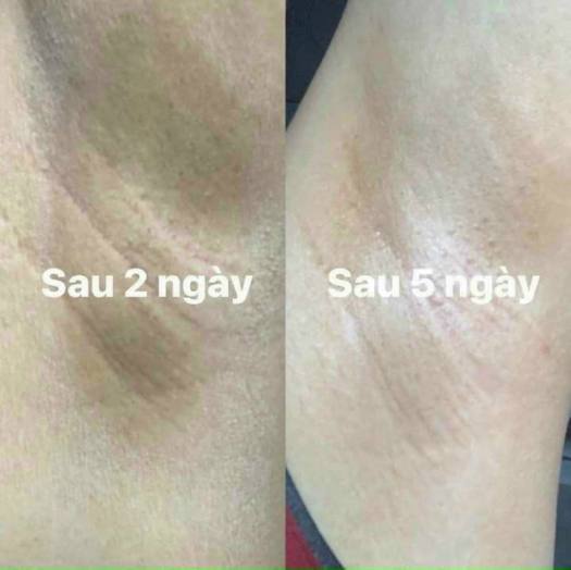 Serum khử thâm X2 Huyền Phi chính hãng, tri thâm nách, mông, bẹn, body cho da trắng sáng tự nhiên