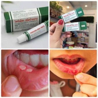 Đánh Bay Nhiệt Miệng NIDA 5G - Chuẩn Thái